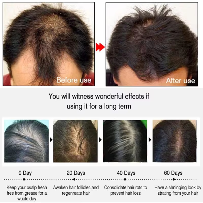 Ginger Hair Growth spray Anti  - Hair Care For Hair Loss recensie en prijs